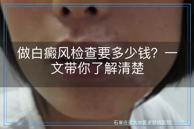 做白癜风检查要多少钱？一文带你了解清楚
