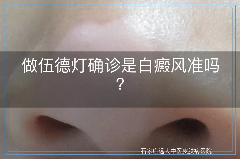 做伍德灯确诊是白癜风准吗？