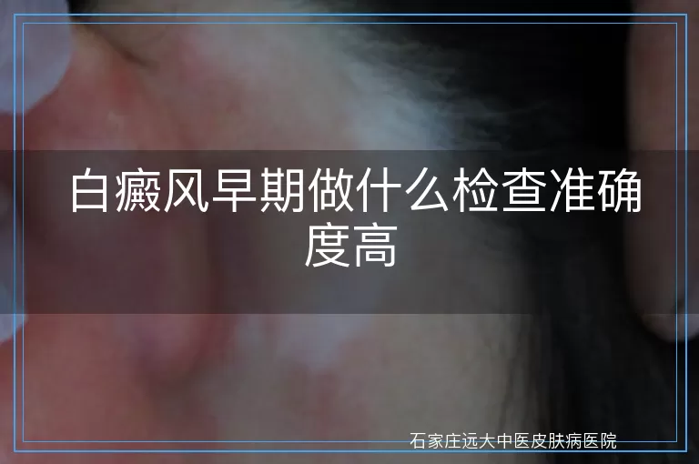 白癜风早期做什么检查准确度高