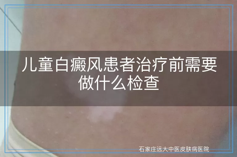 儿童白癜风患者治疗前需要做什么检查