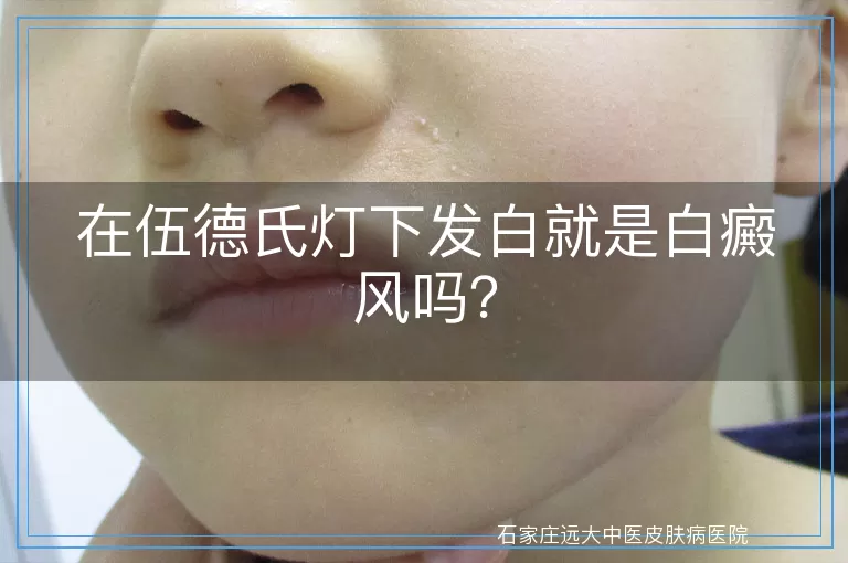 在伍德氏灯下发白就是白癜风吗？