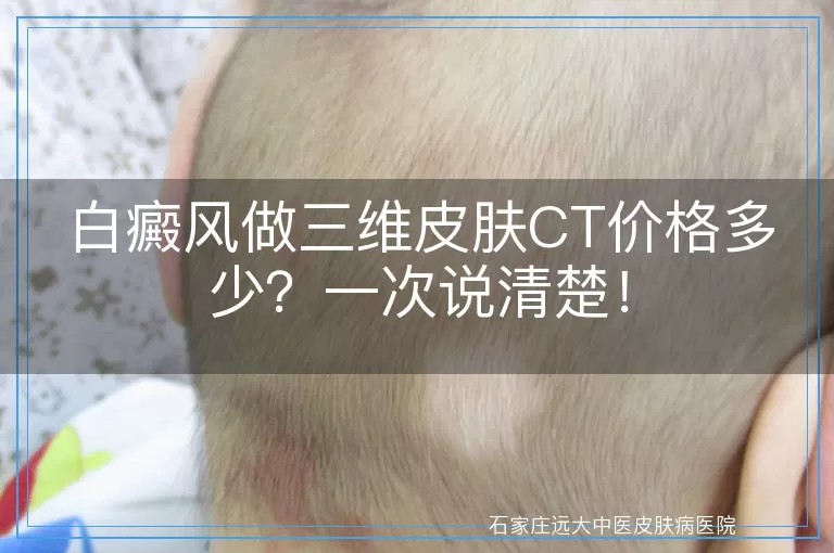 白癜风做三维皮肤CT价格多少？一次说清楚！