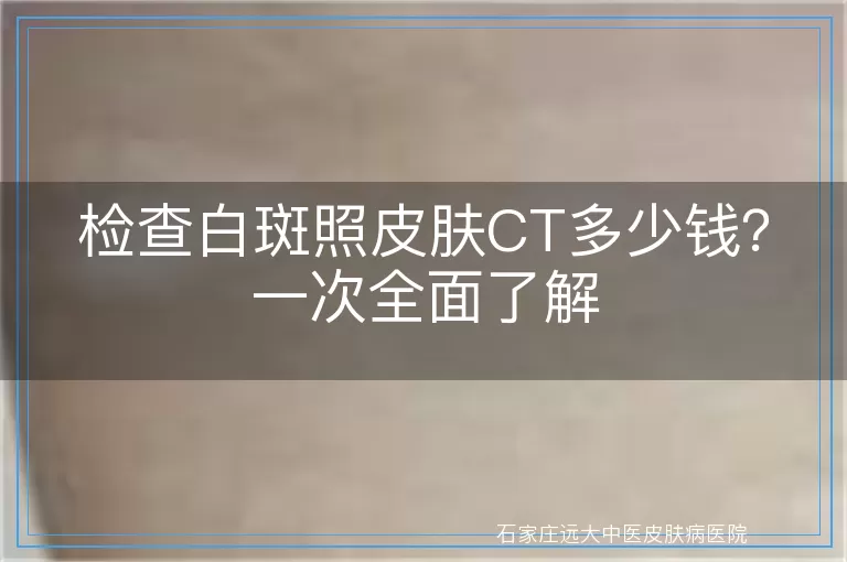 检查白斑照皮肤CT多少钱？一次全面了解