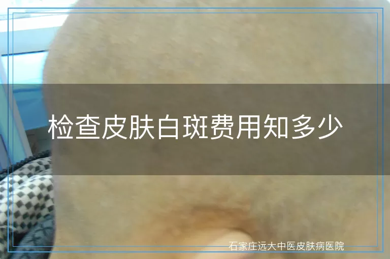 检查皮肤白斑费用知多少