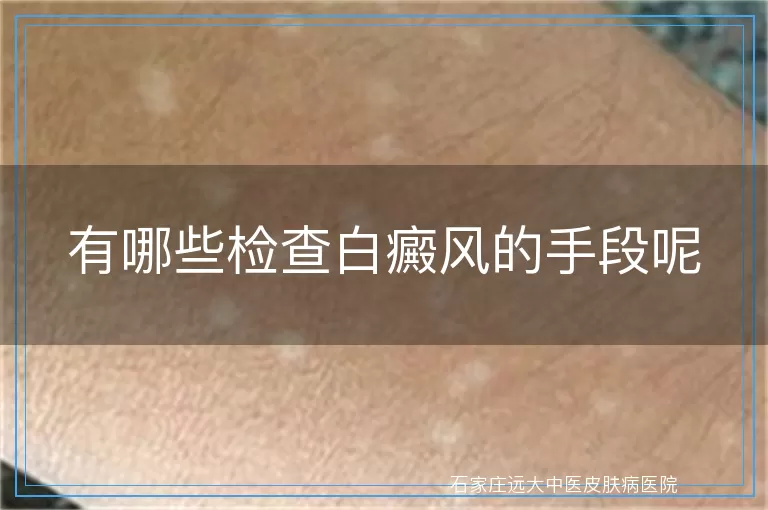 有哪些检查白癜风的手段呢