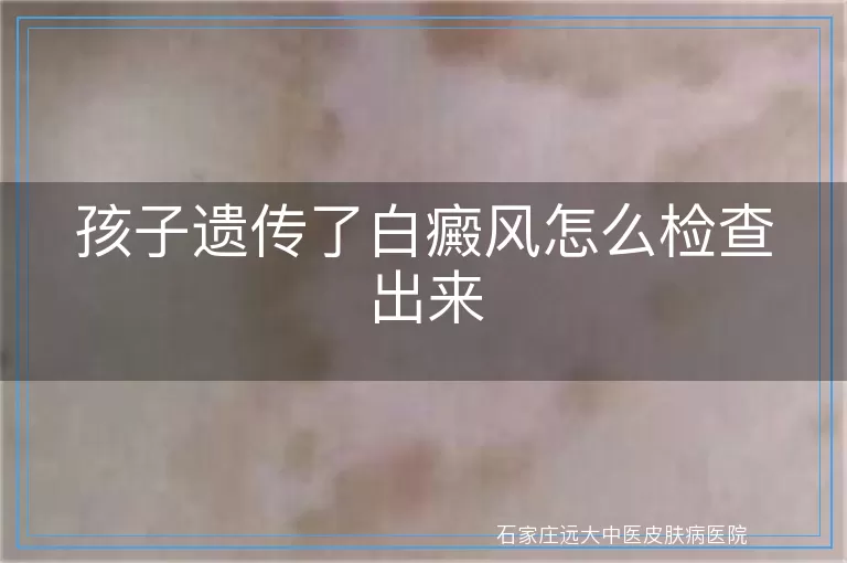 孩子遗传了白癜风怎么检查出来