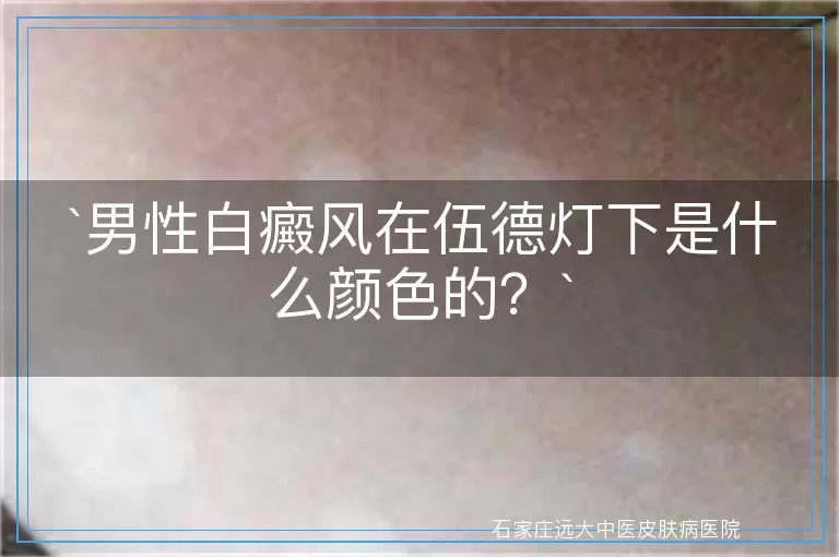 男性白癜风在伍德灯下是什么颜色的？