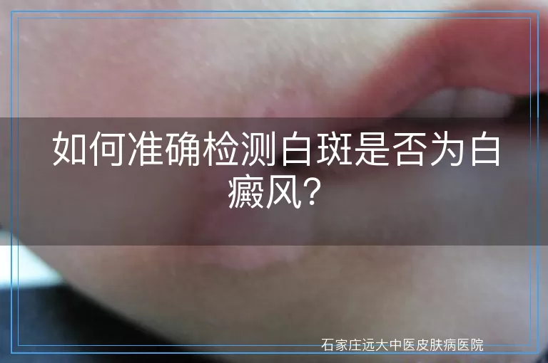 如何准确检测白斑是否为白癜风？