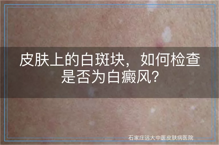 皮肤上的白斑块，如何检查是否为白癜风？