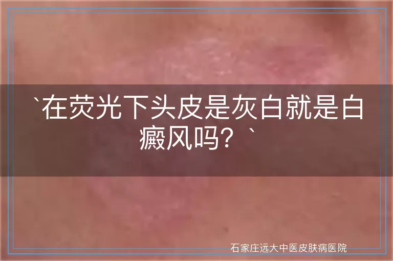 在荧光下头皮是灰白就是白癜风吗？
