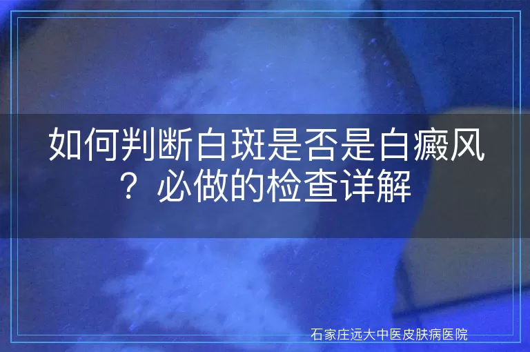 如何判断白斑是否是白癜风？必做的检查详解