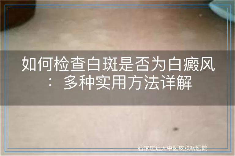 如何检查白斑是否为白癜风：多种实用方法详解