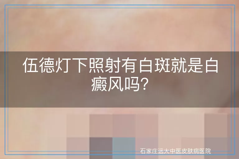 伍德灯下照射有白斑就是白癜风吗？