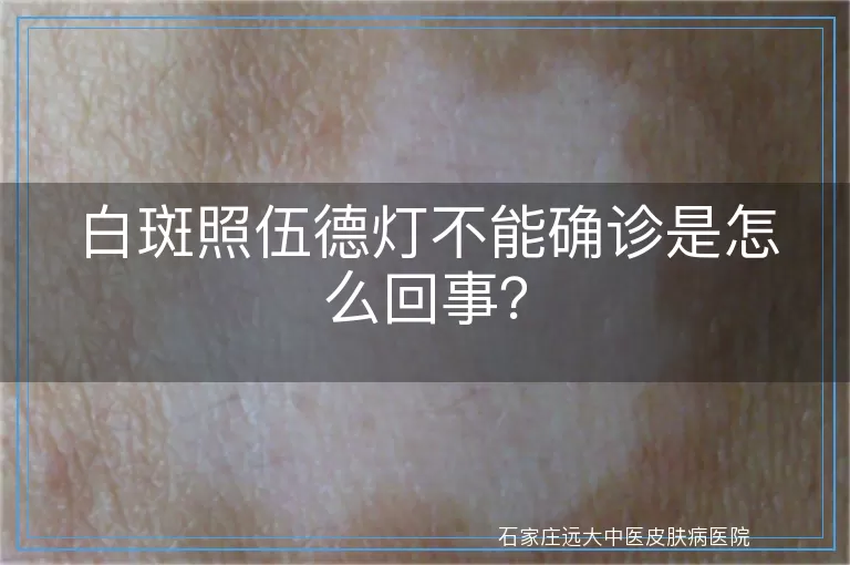 白斑照伍德灯不能确诊是怎么回事？