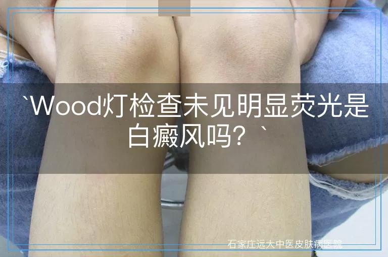 Wood灯检查未见明显荧光是白癜风吗？