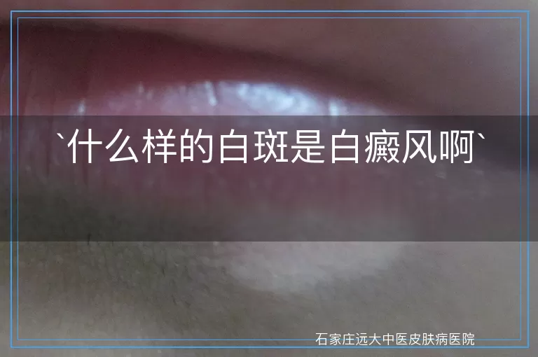 什么样的白斑是白癜风啊
