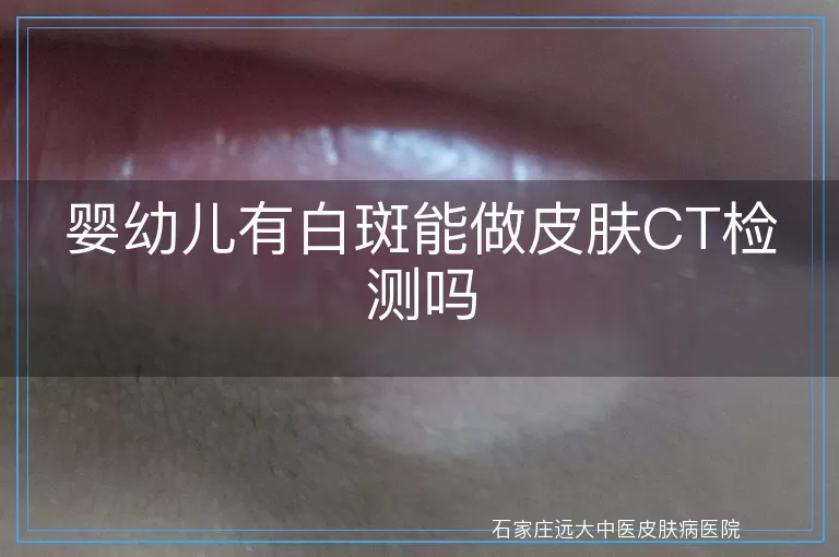 婴幼儿有白斑能做皮肤CT检测吗