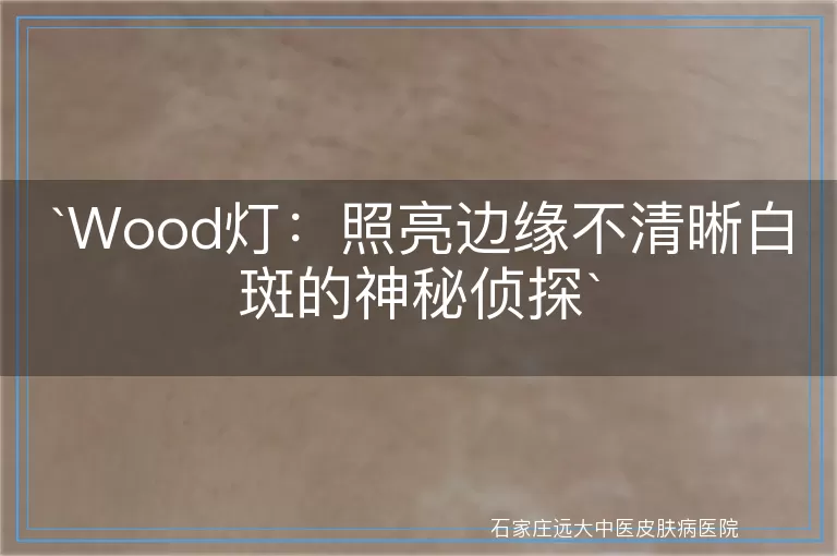Wood灯：照亮边缘不清晰白斑的神秘侦探