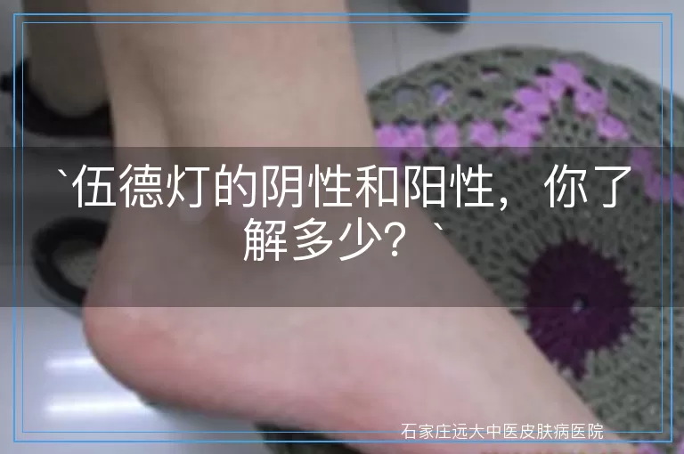 伍德灯的阴性和阳性，你了解多少？