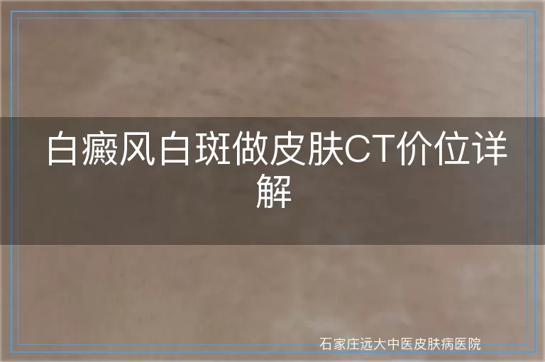 白癜风白斑做皮肤CT价位详解