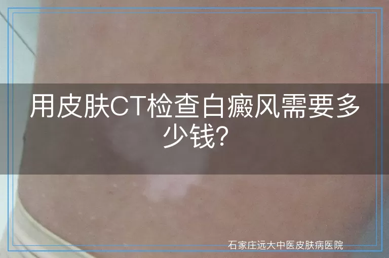 用皮肤CT检查白癜风需要多少钱？