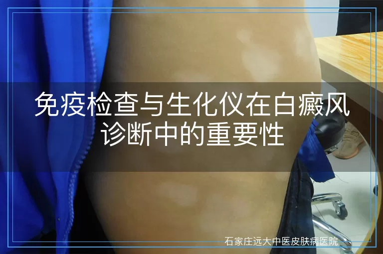 免疫检查与生化仪在白癜风诊断中的重要性