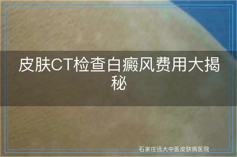 皮肤CT检查白癜风费用大揭秘