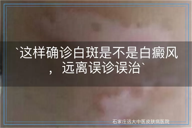 这样确诊白斑是不是白癜风，远离误诊误治