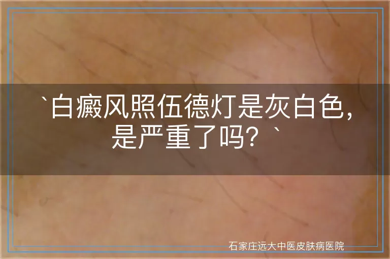 白癜风照伍德灯是灰白色，是严重了吗？