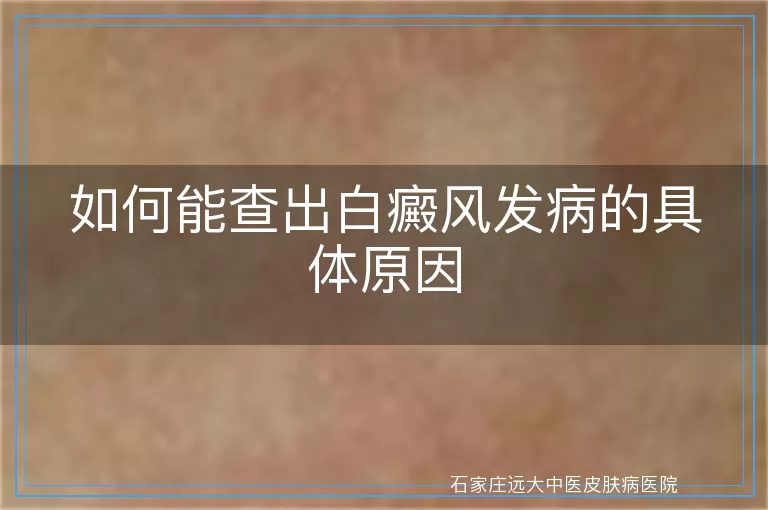 如何能查出白癜风发病的具体原因