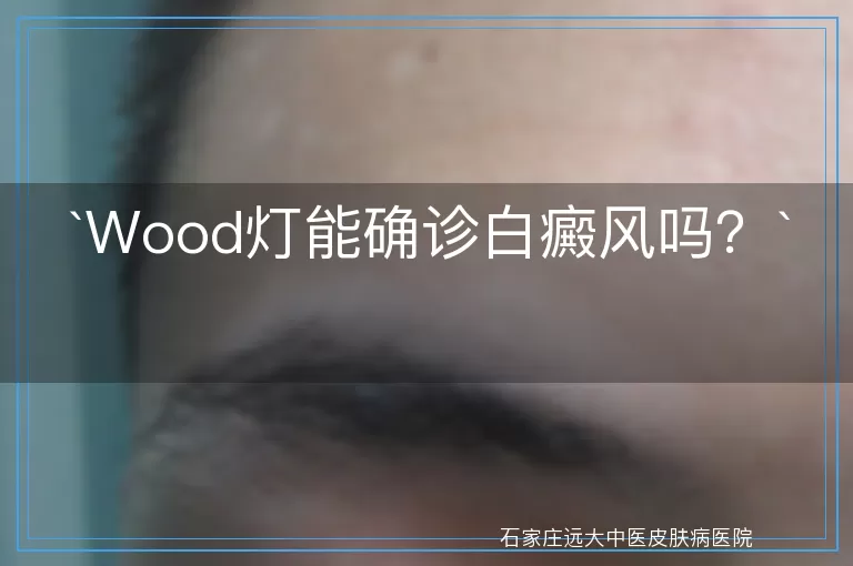 Wood灯能确诊白癜风吗？