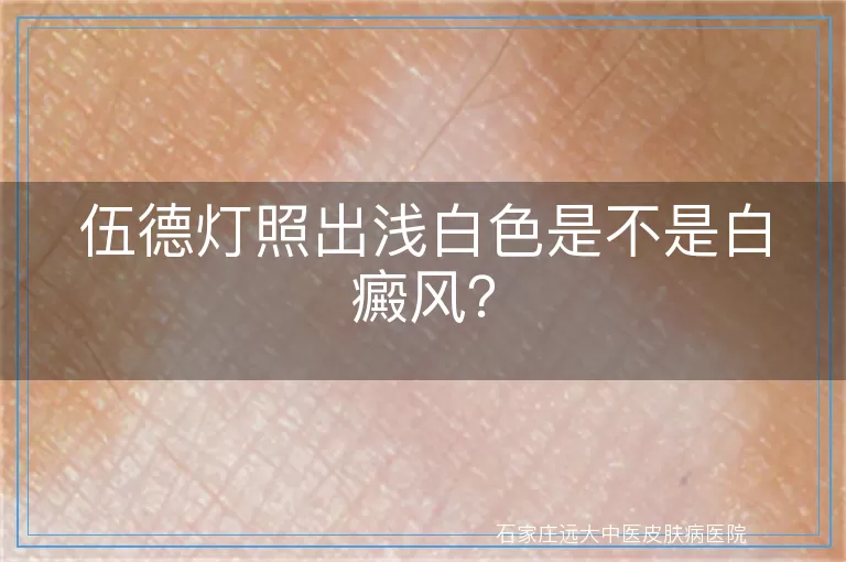 伍德灯照出浅白色是不是白癜风？