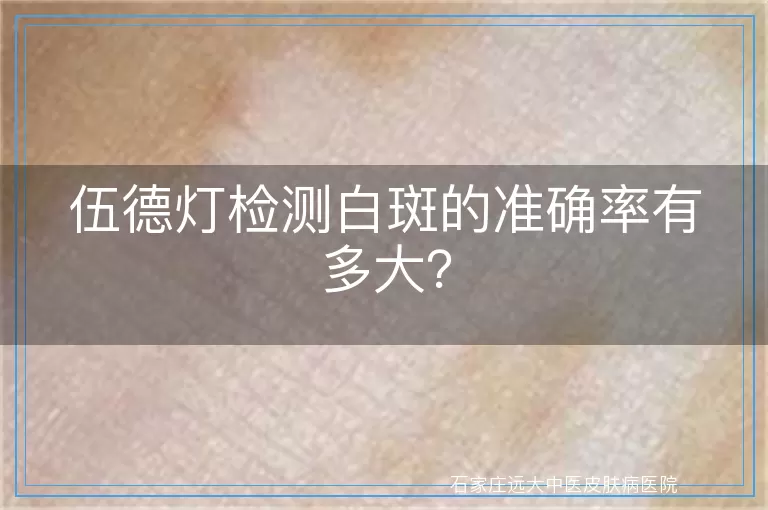 伍德灯检测白斑的准确率有多大？