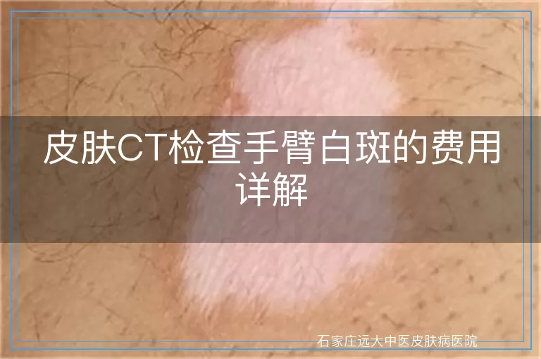 皮肤CT检查手臂白斑的费用详解