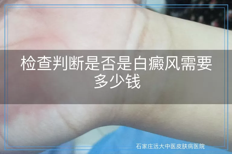 检查判断是否是白癜风需要多少钱