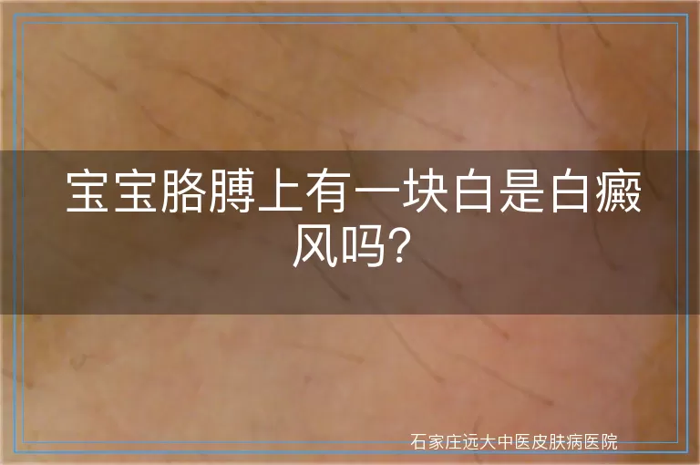 宝宝胳膊上有一块白是白癜风吗？
