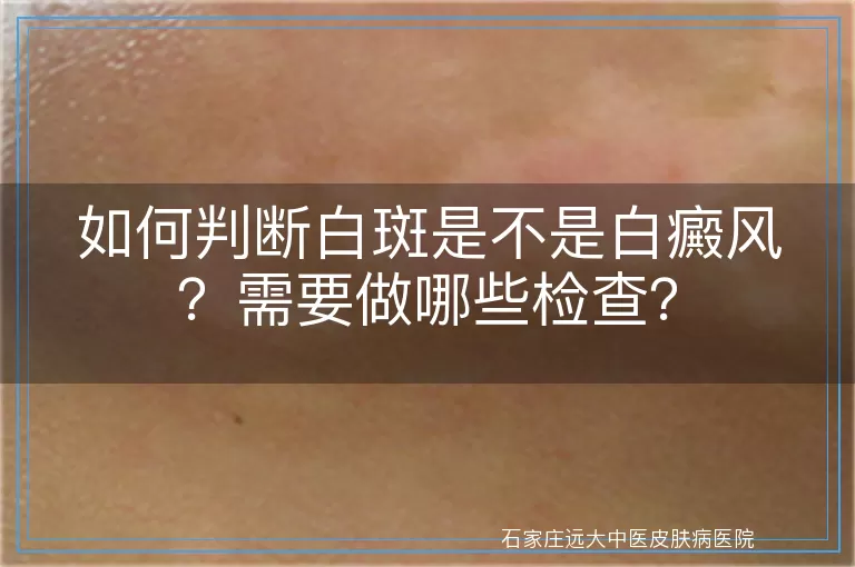 如何判断白斑是不是白癜风？需要做哪些检查？