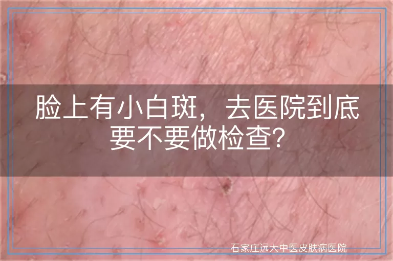 脸上有小白斑，去医院到底要不要做检查？
