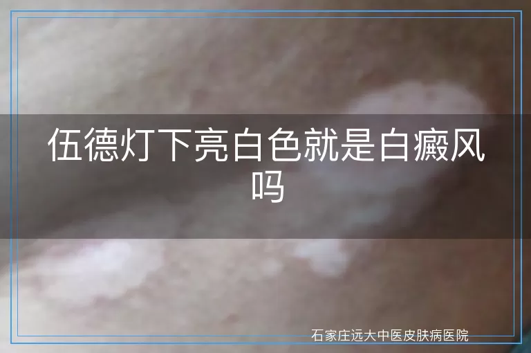 伍德灯下亮白色就是白癜风吗