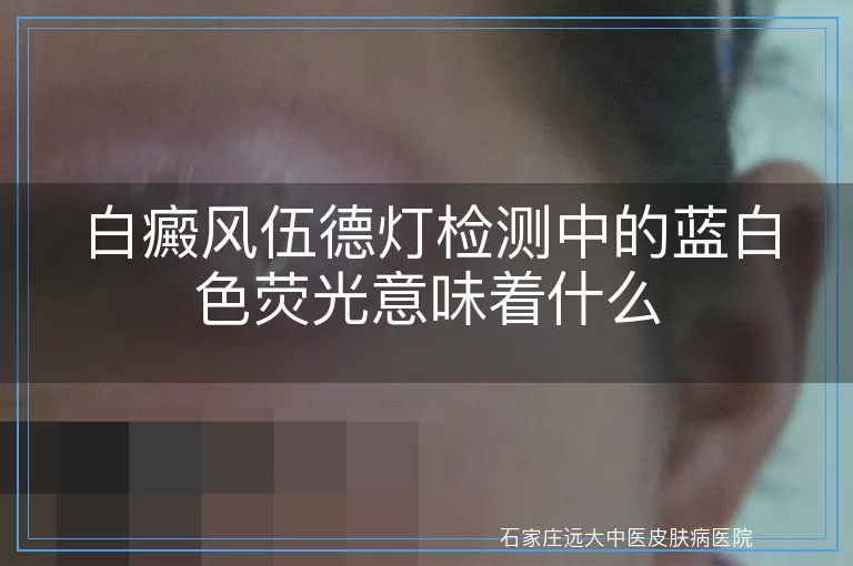 白癜风伍德灯检测中的蓝白色荧光意味着什么