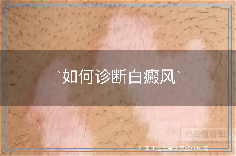 如何诊断白癜风