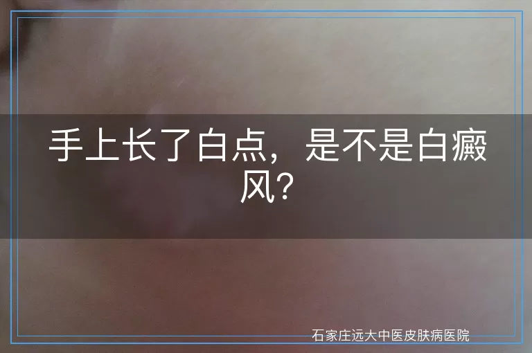 手上长了白点，是不是白癜风？