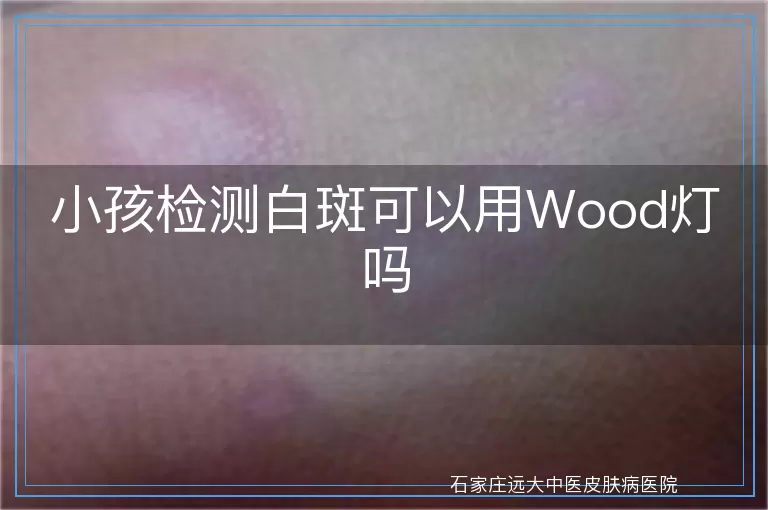小孩检测白斑可以用Wood灯吗