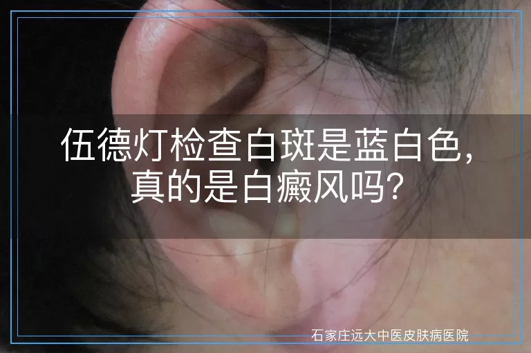 伍德灯检查白斑是蓝白色，真的是白癜风吗？