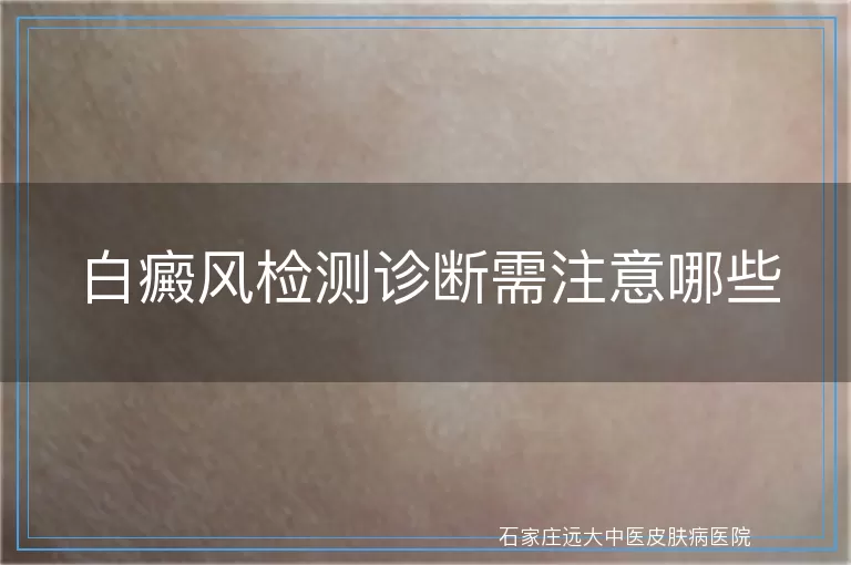白癜风检测诊断需注意哪些