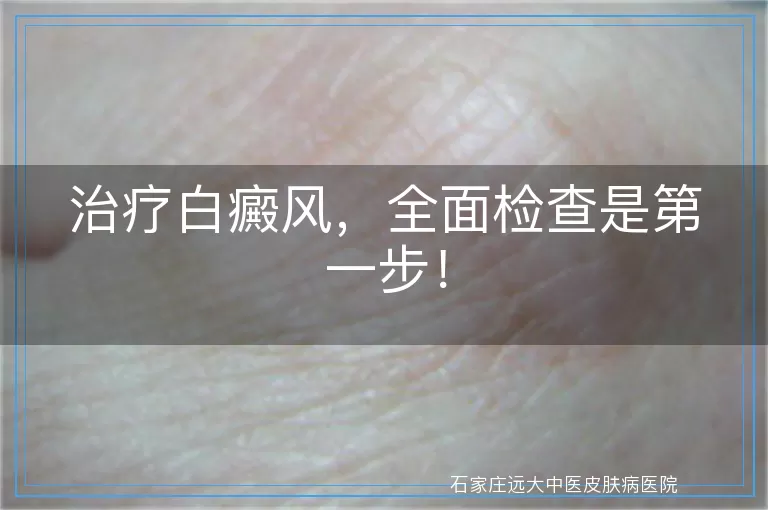 治疗白癜风，全面检查是第一步！