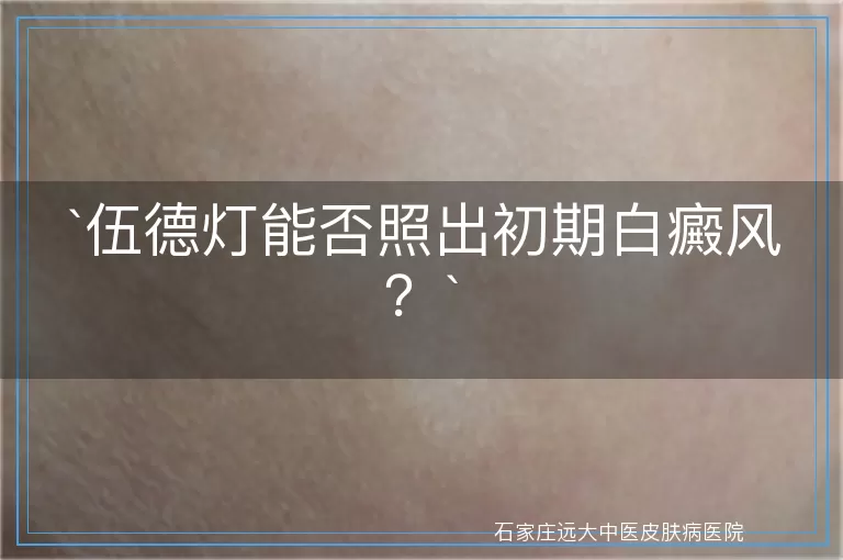 伍德灯能否照出初期白癜风？