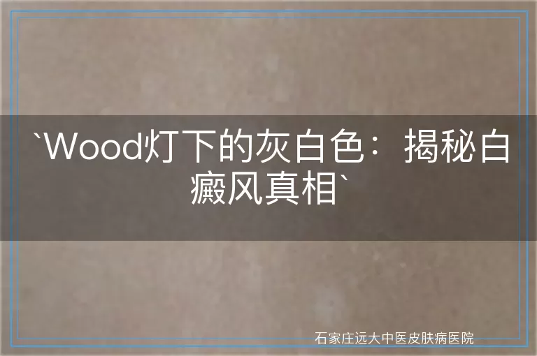 Wood灯下的灰白色：揭秘白癜风真相