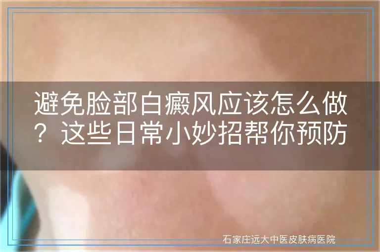 避免脸部白癜风应该怎么做？这些日常小妙招帮你预防！