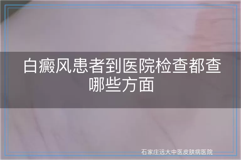 白癜风患者到医院检查都查哪些方面